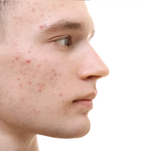 Before-Acne Treatment