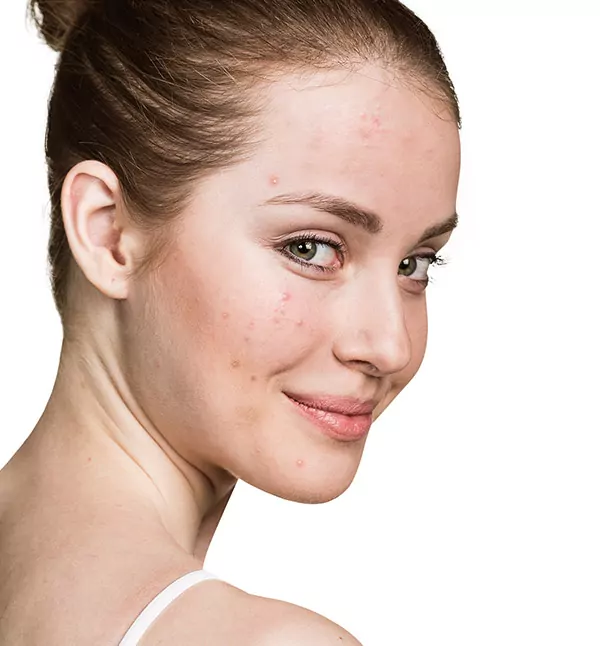 Before-Acne Treatment