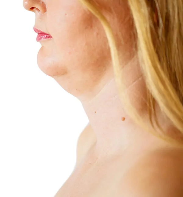 Before-Double Chin Treatment