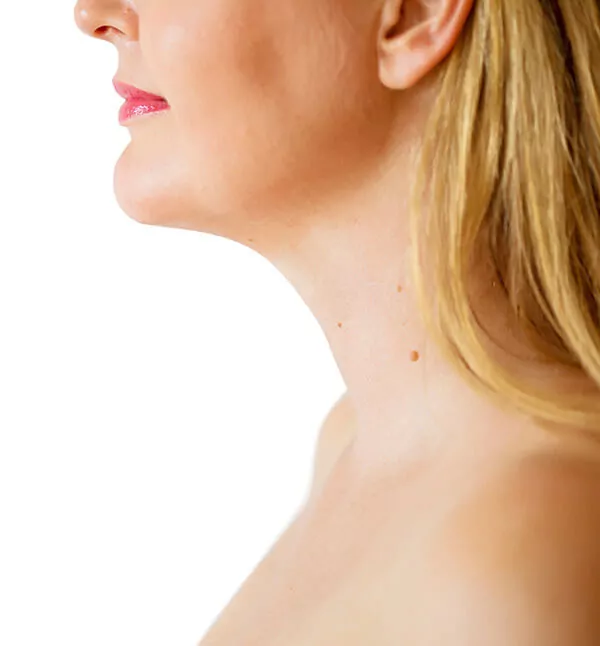 After-Double Chin Treatment